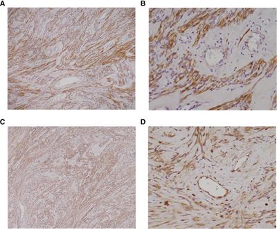 Case Report: Myomatous erythrocytosis syndrome presenting as rapid growth of an extra-uterine mass